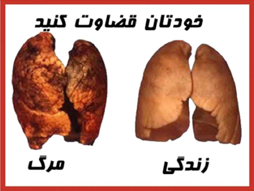 Iran 2009 Health Effects Death - Life or death, diseased lung